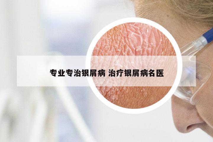 专业专治银屑病 治疗银屑病名医