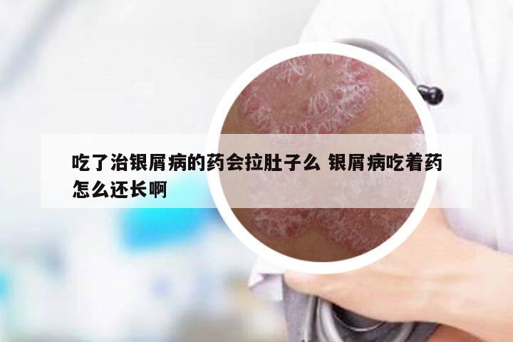 吃了治银屑病的药会拉肚子么 银屑病吃着药怎么还长啊