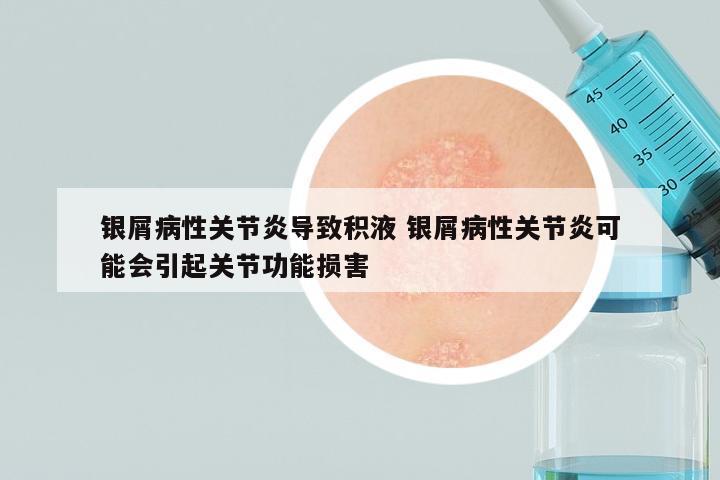 银屑病性关节炎导致积液 银屑病性关节炎可能会引起关节功能损害