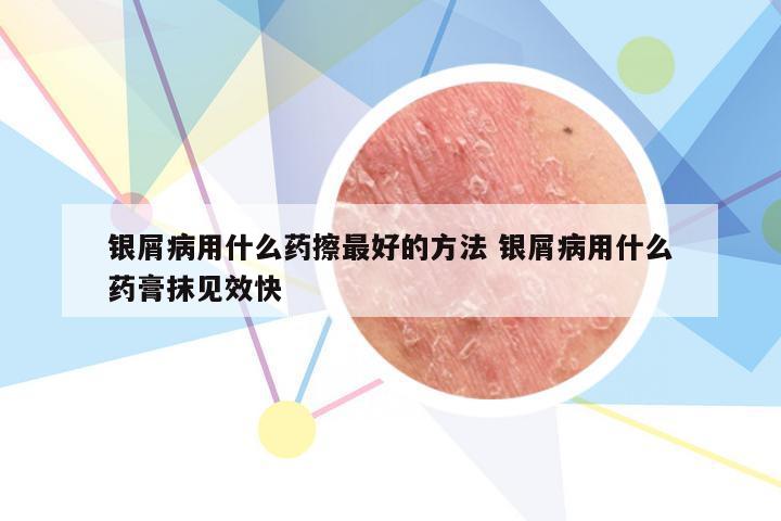 银屑病用什么药擦最好的方法 银屑病用什么药膏抹见效快
