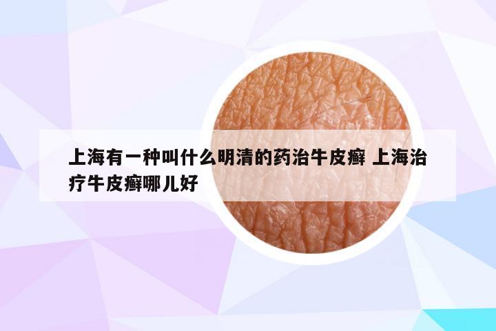 上海有一种叫什么明清的药治牛皮癣 上海治疗牛皮癣哪儿好