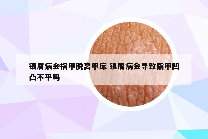 银屑病会指甲脱离甲床 银屑病会导致指甲凹凸不平吗