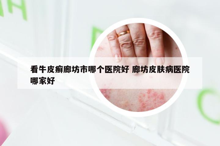 看牛皮癣廊坊市哪个医院好 廊坊皮肤病医院哪家好