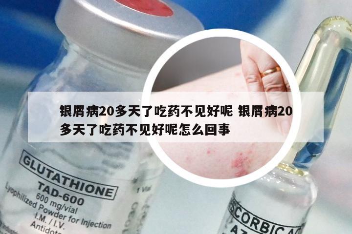 银屑病20多天了吃药不见好呢 银屑病20多天了吃药不见好呢怎么回事