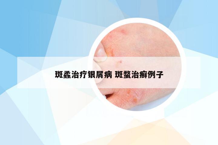 斑蟊治疗银屑病 斑蝥治癣例子