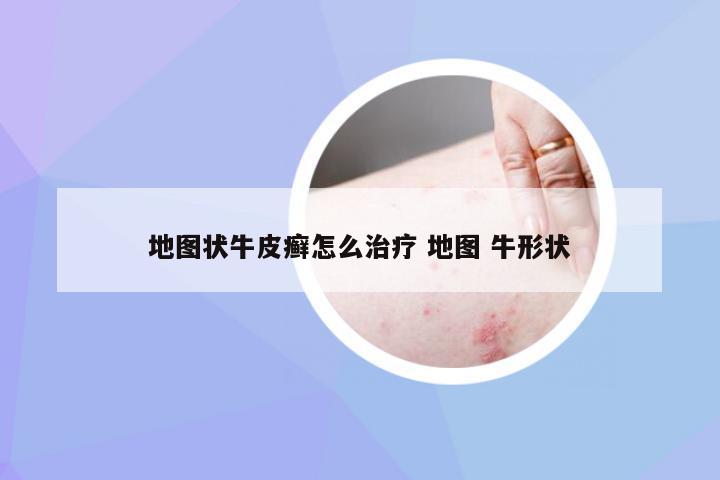 地图状牛皮癣怎么治疗 地图 牛形状