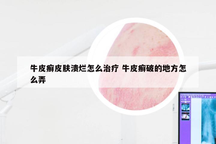牛皮癣皮肤溃烂怎么治疗 牛皮癣破的地方怎么弄