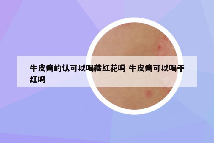 牛皮癣的认可以喝藏红花吗 牛皮癣可以喝干红吗