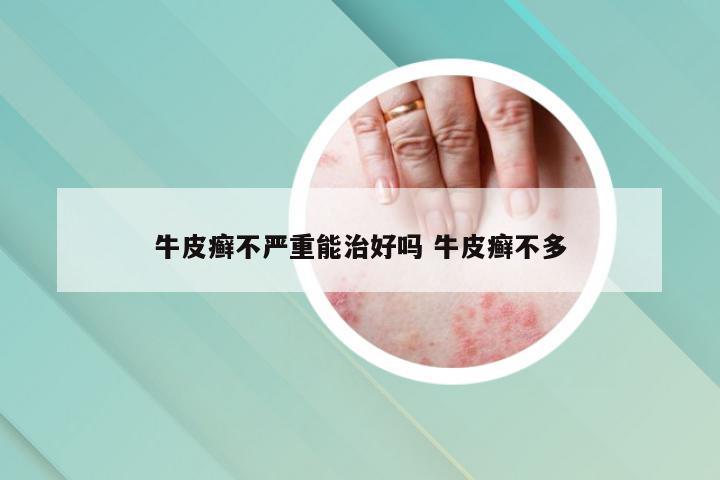 牛皮癣不严重能治好吗 牛皮癣不多