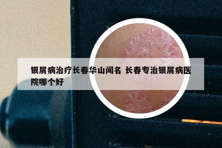 银屑病治疗长春华山闻名 长春专治银屑病医院哪个好