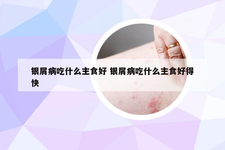 银屑病吃什么主食好 银屑病吃什么主食好得快