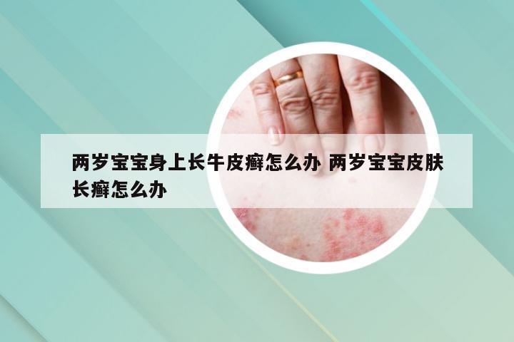 两岁宝宝身上长牛皮癣怎么办 两岁宝宝皮肤长癣怎么办