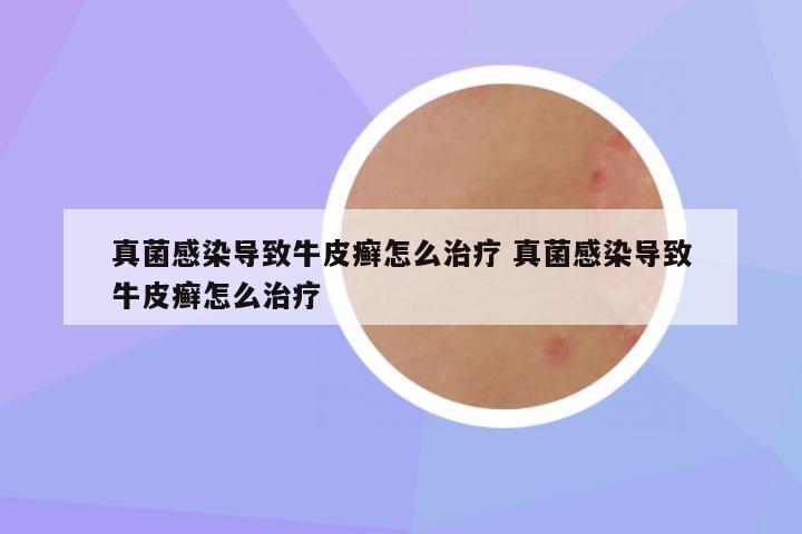 真菌感染导致牛皮癣怎么治疗 真菌感染导致牛皮癣怎么治疗