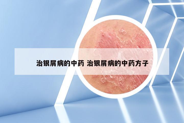 治银屑病的中药 治银屑病的中药方子