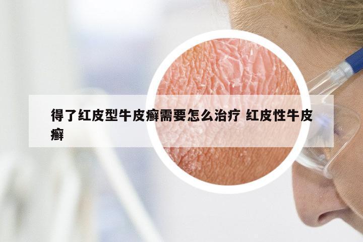 得了红皮型牛皮癣需要怎么治疗 红皮性牛皮癣