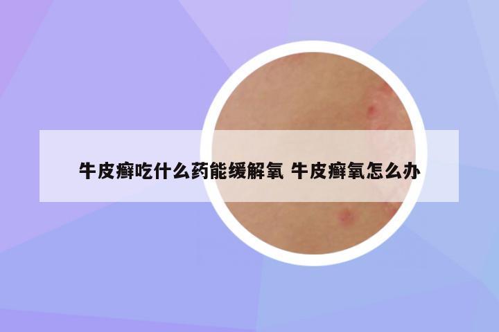 牛皮癣吃什么药能缓解氧 牛皮癣氧怎么办
