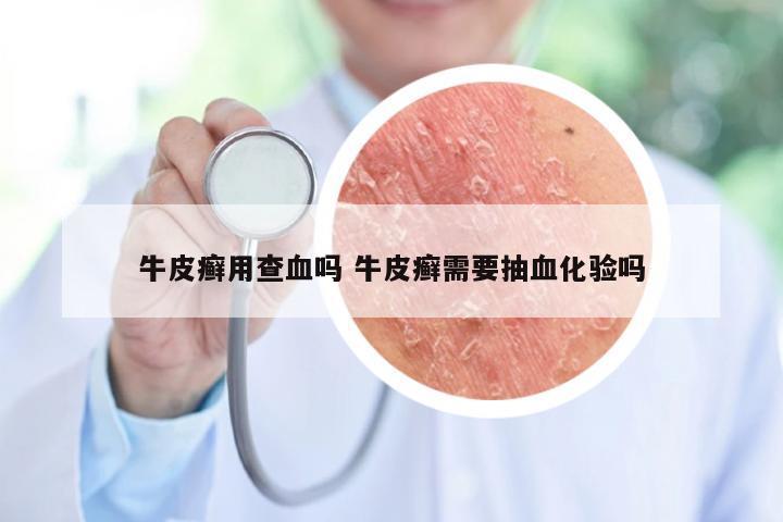 牛皮癣用查血吗 牛皮癣需要抽血化验吗