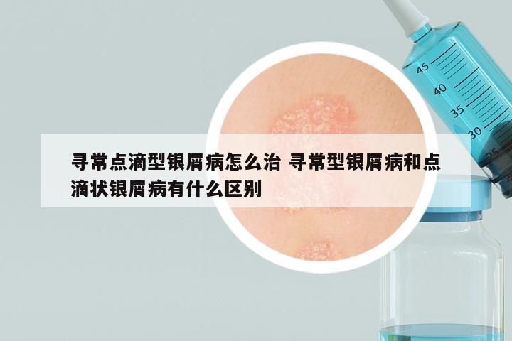 寻常点滴型银屑病怎么治 寻常型银屑病和点滴状银屑病有什么区别