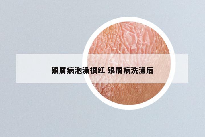 银屑病泡澡很红 银屑病洗澡后