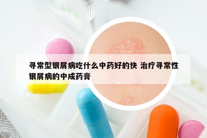 寻常型银屑病吃什么中药好的快 治疗寻常性银屑病的中成药膏
