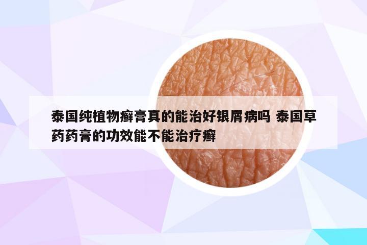 泰国纯植物癣膏真的能治好银屑病吗 泰国草药药膏的功效能不能治疗癣