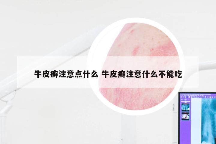 牛皮癣注意点什么 牛皮癣注意什么不能吃