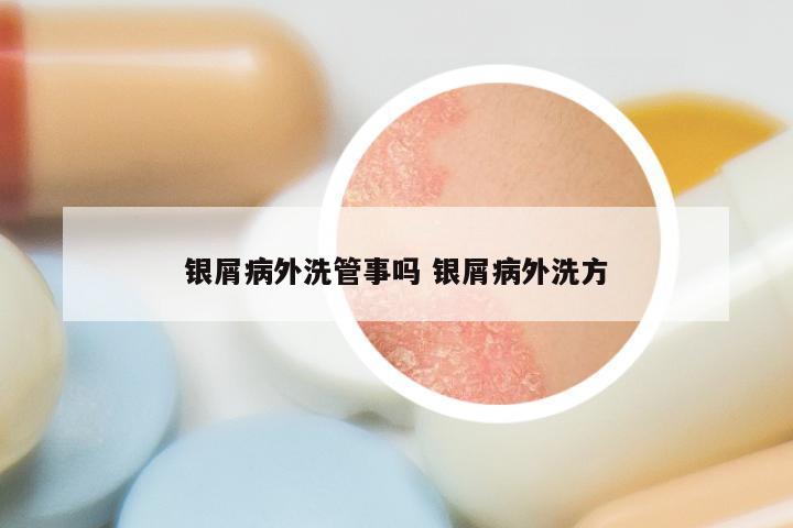 银屑病外洗管事吗 银屑病外洗方
