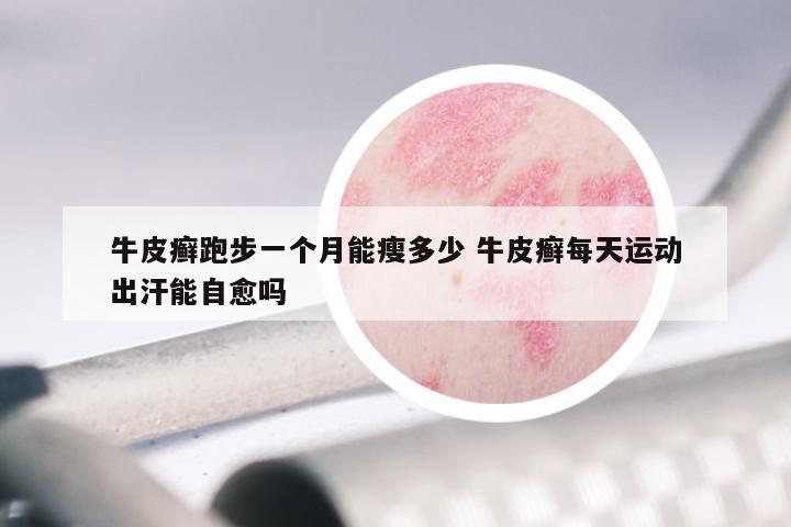 牛皮癣跑步一个月能瘦多少 牛皮癣每天运动出汗能自愈吗