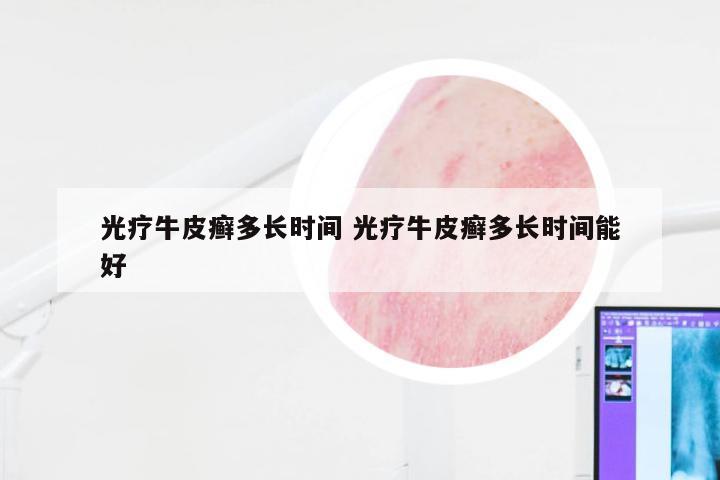 光疗牛皮癣多长时间 光疗牛皮癣多长时间能好