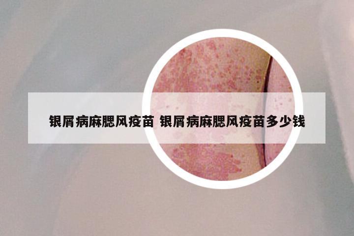 银屑病麻腮风疫苗 银屑病麻腮风疫苗多少钱