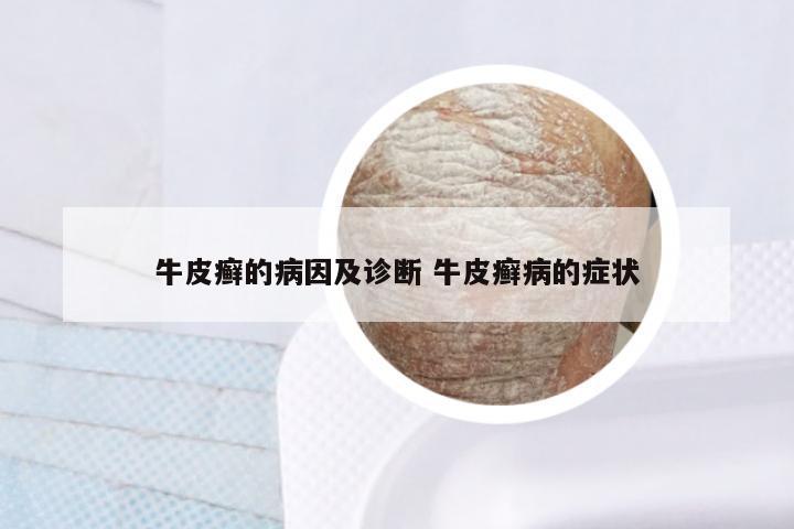 牛皮癣的病因及诊断 牛皮癣病的症状