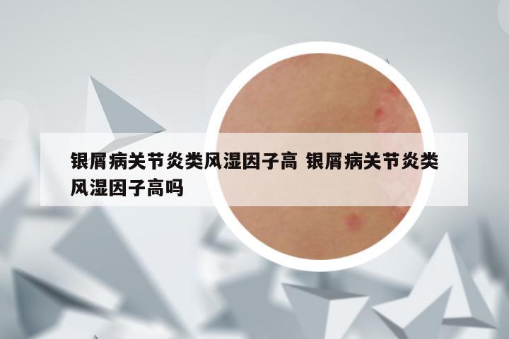 银屑病关节炎类风湿因子高 银屑病关节炎类风湿因子高吗