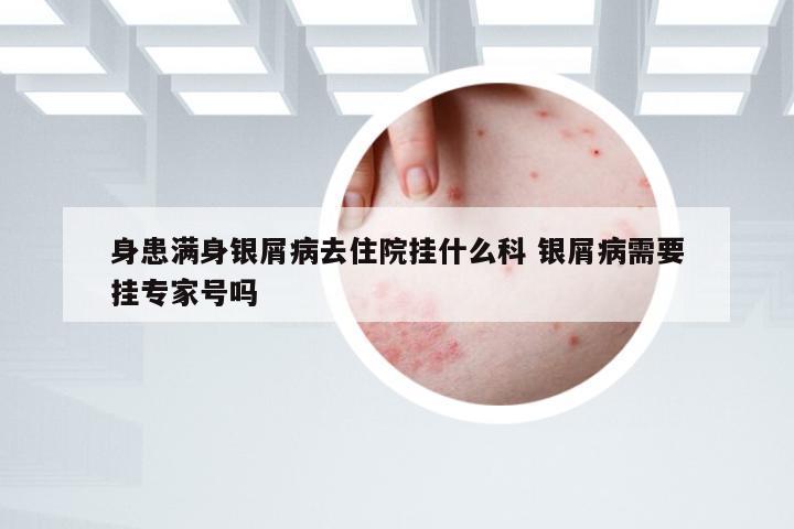 身患满身银屑病去住院挂什么科 银屑病需要挂专家号吗