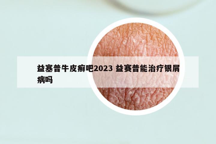 益塞普牛皮癣吧2023 益赛普能治疗银屑病吗