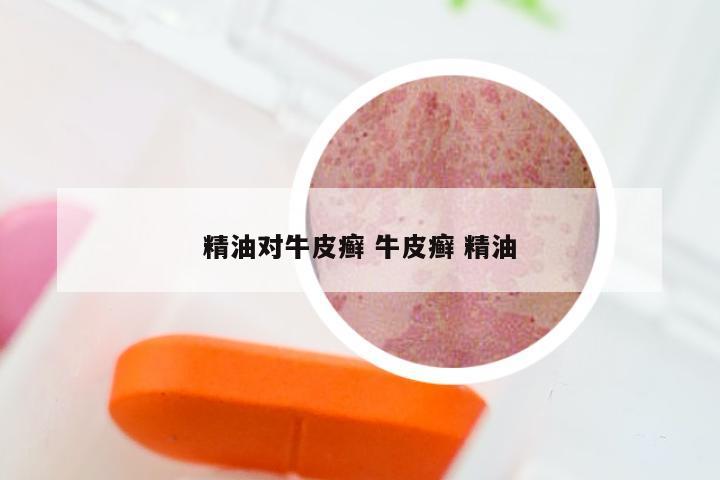 精油对牛皮癣 牛皮癣 精油