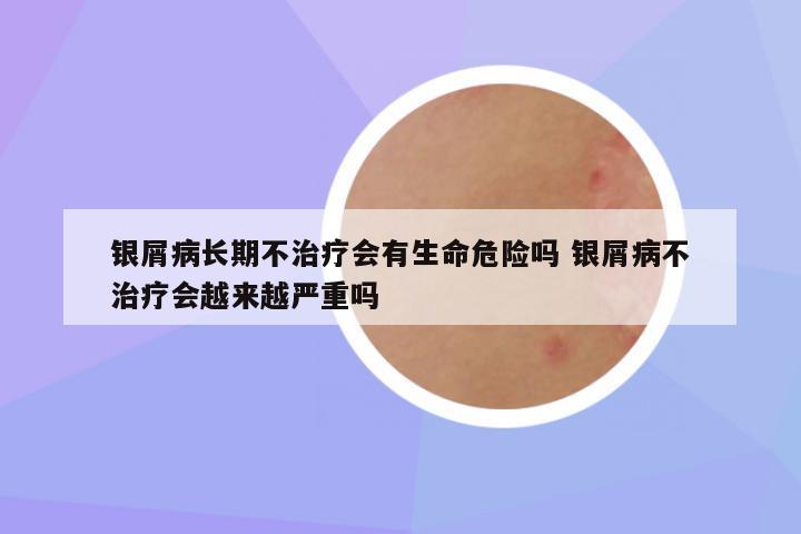 银屑病长期不治疗会有生命危险吗 银屑病不治疗会越来越严重吗
