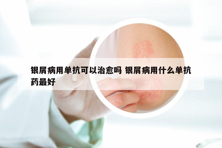银屑病用单抗可以治愈吗 银屑病用什么单抗药最好