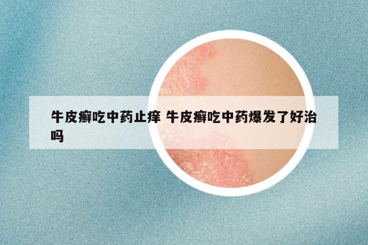 牛皮癣吃中药止痒 牛皮癣吃中药爆发了好治吗