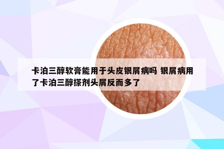 卡泊三醇软膏能用于头皮银屑病吗 银屑病用了卡泊三醇搽剂头屑反而多了