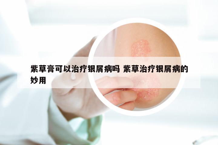 紫草膏可以治疗银屑病吗 紫草治疗银屑病的妙用