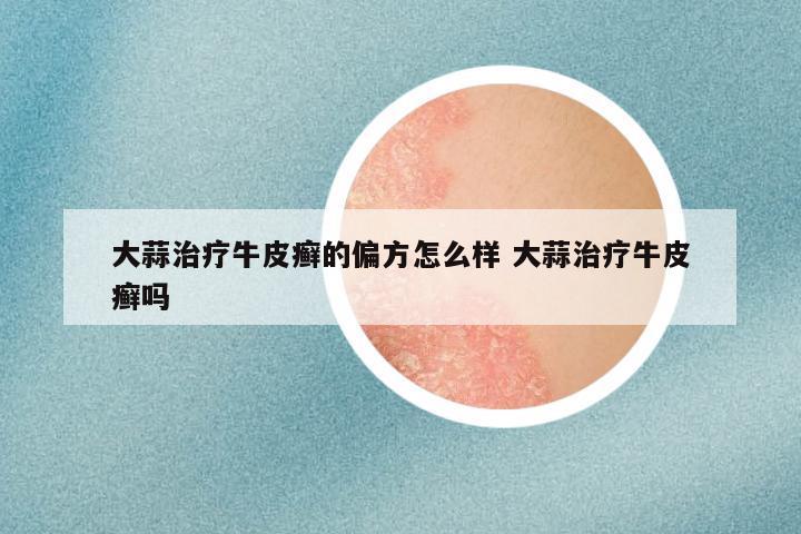 大蒜治疗牛皮癣的偏方怎么样 大蒜治疗牛皮癣吗