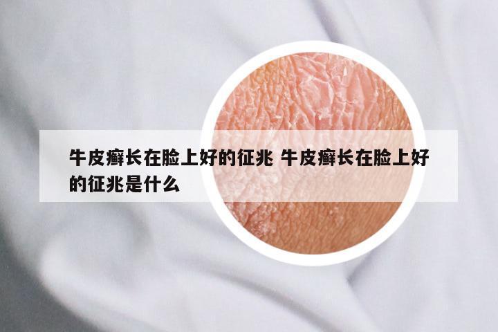 牛皮癣长在脸上好的征兆 牛皮癣长在脸上好的征兆是什么