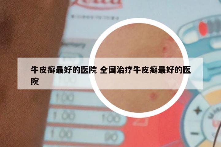 牛皮癣最好的医院 全国治疗牛皮癣最好的医院