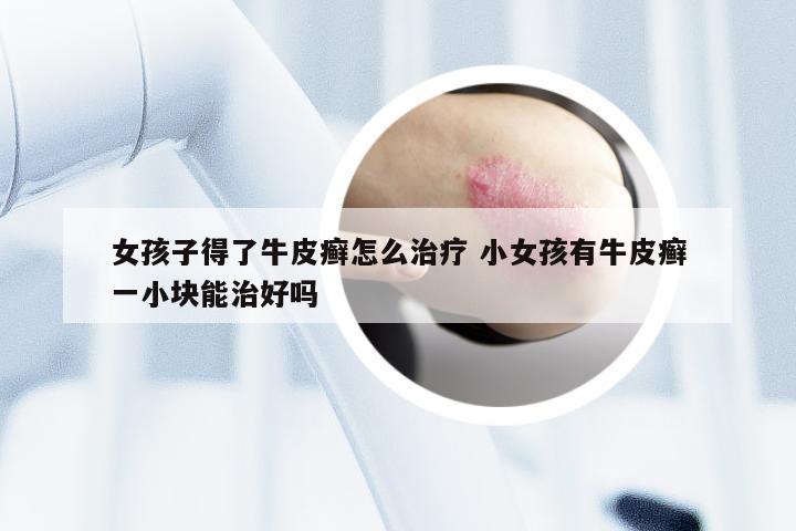 女孩子得了牛皮癣怎么治疗 小女孩有牛皮癣一小块能治好吗