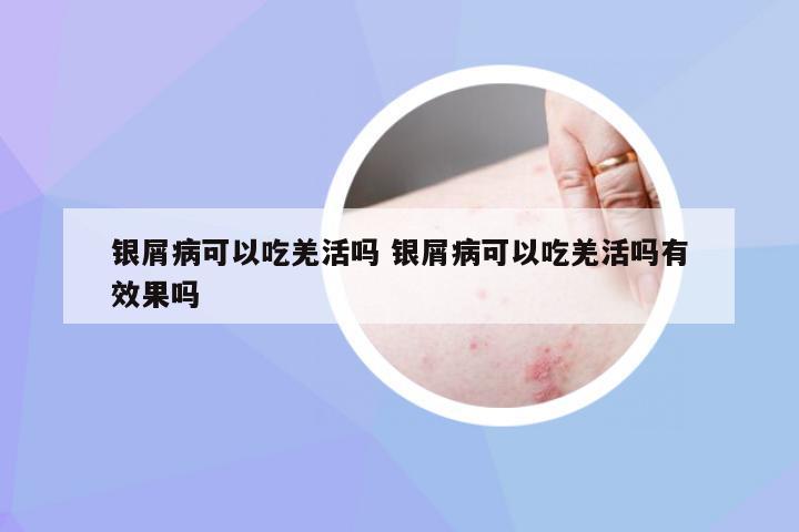 银屑病可以吃羌活吗 银屑病可以吃羌活吗有效果吗