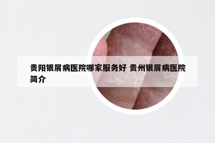 贵阳银屑病医院哪家服务好 贵州银屑病医院简介