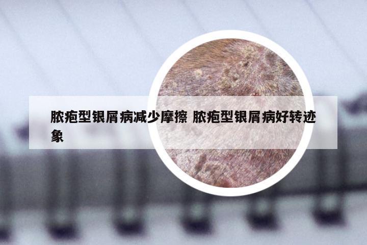 脓疱型银屑病减少摩擦 脓疱型银屑病好转迹象