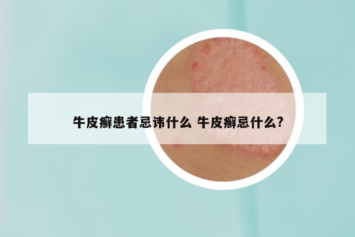 牛皮癣患者忌讳什么 牛皮癣忌什么?
