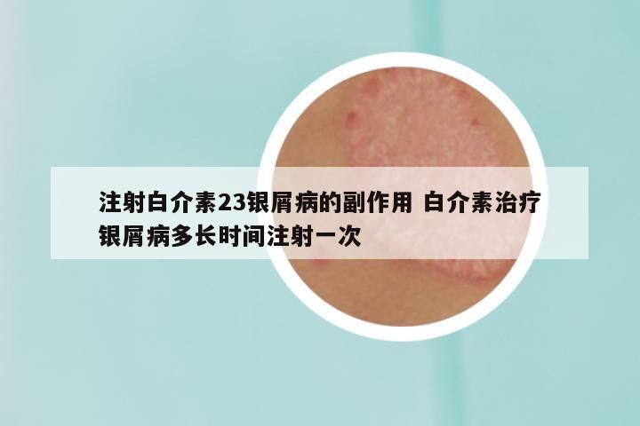 注射白介素23银屑病的副作用 白介素治疗银屑病多长时间注射一次