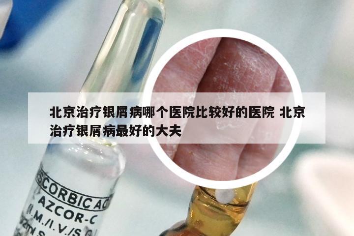 北京治疗银屑病哪个医院比较好的医院 北京治疗银屑病最好的大夫